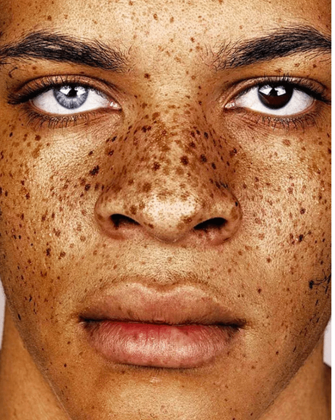 La bellezza delle lentiggini in una
