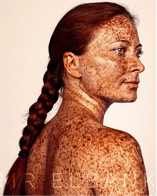 La bellezza delle lentiggini in una serie di foto TPI