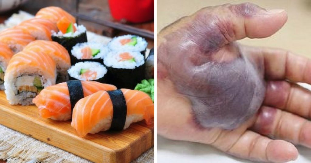 sushi infezione