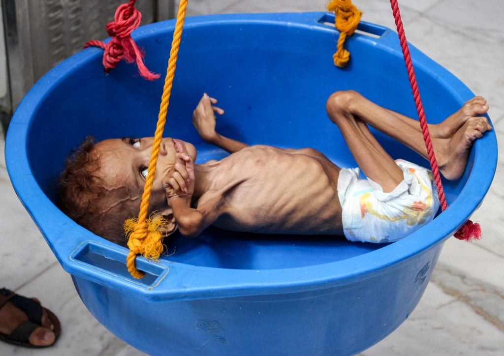 Yemen bambini carestia