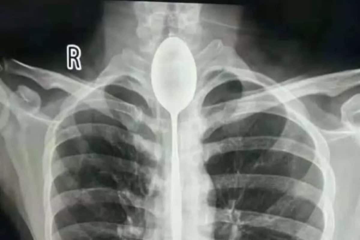 radiografia cucchiaio ingoiato