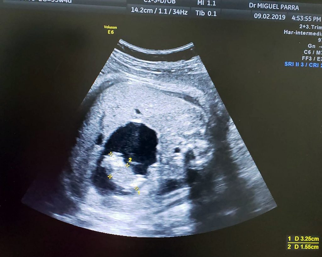 bambina feto gemella colombia