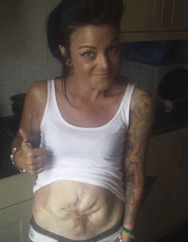 esplode intestino trapianto.