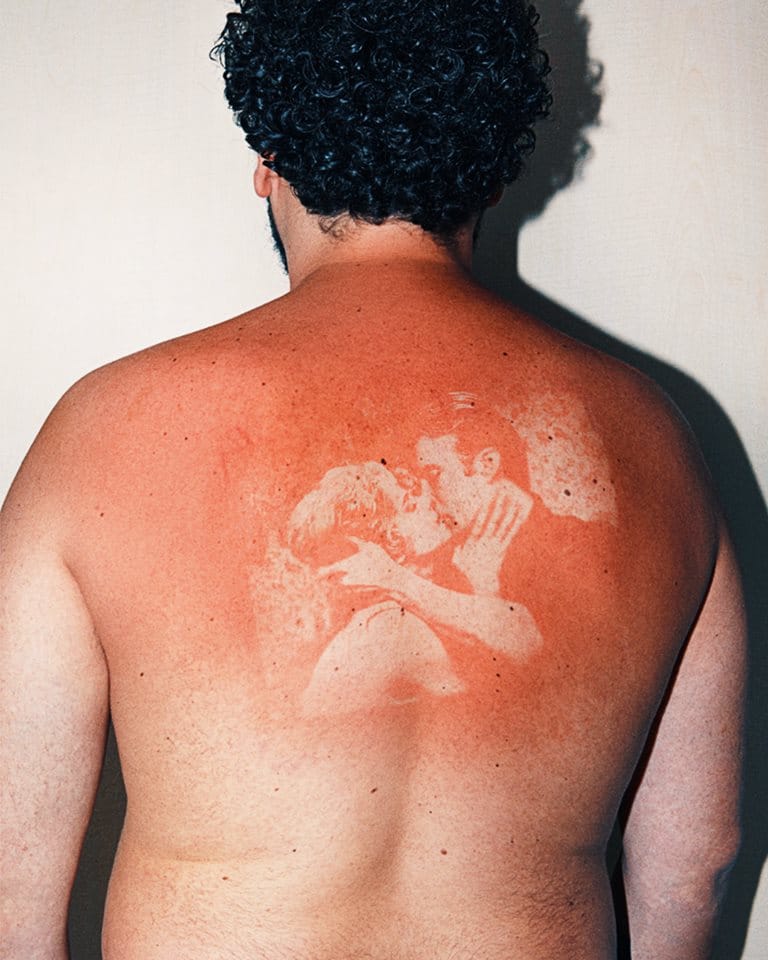 sunburn tattoo