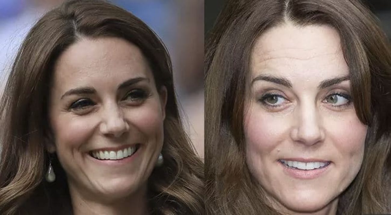 Kate Middleton botox