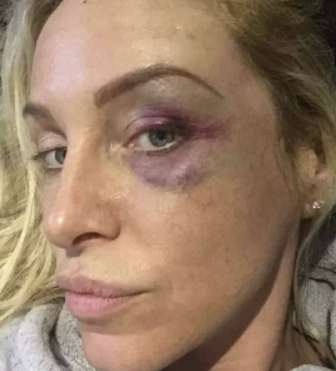 vincitrice grande fratello aggredita