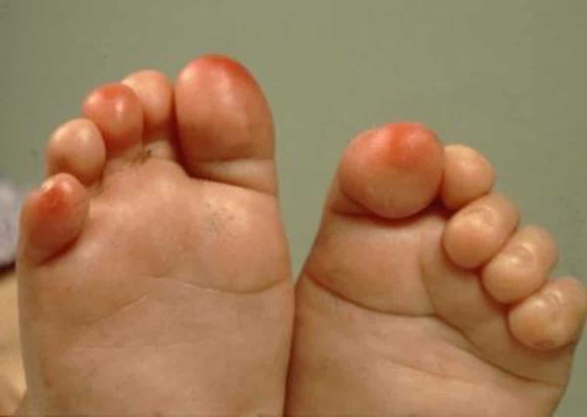 geloni piedi bambini coronavirus