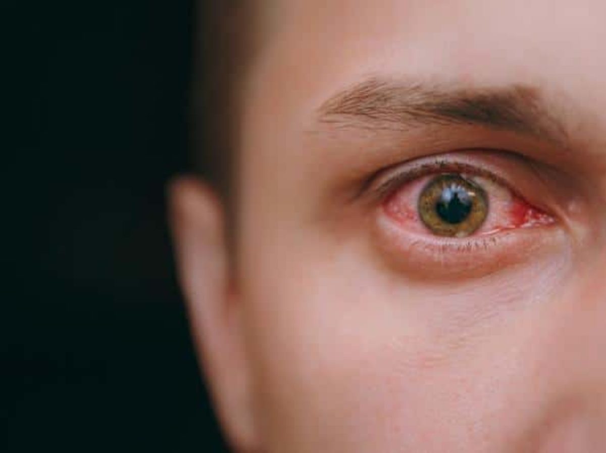 coronavirus occhi