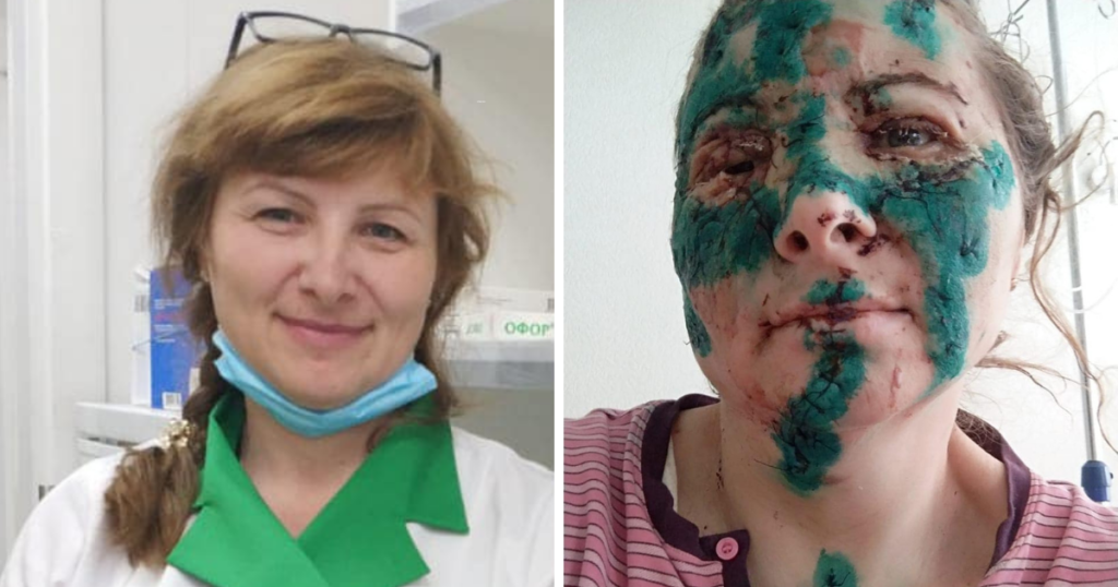 ucraina infermiera sfigurata
