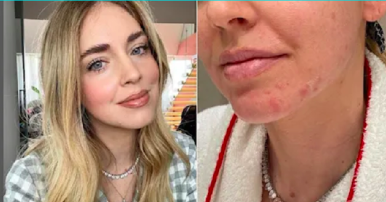 Ferragni acne